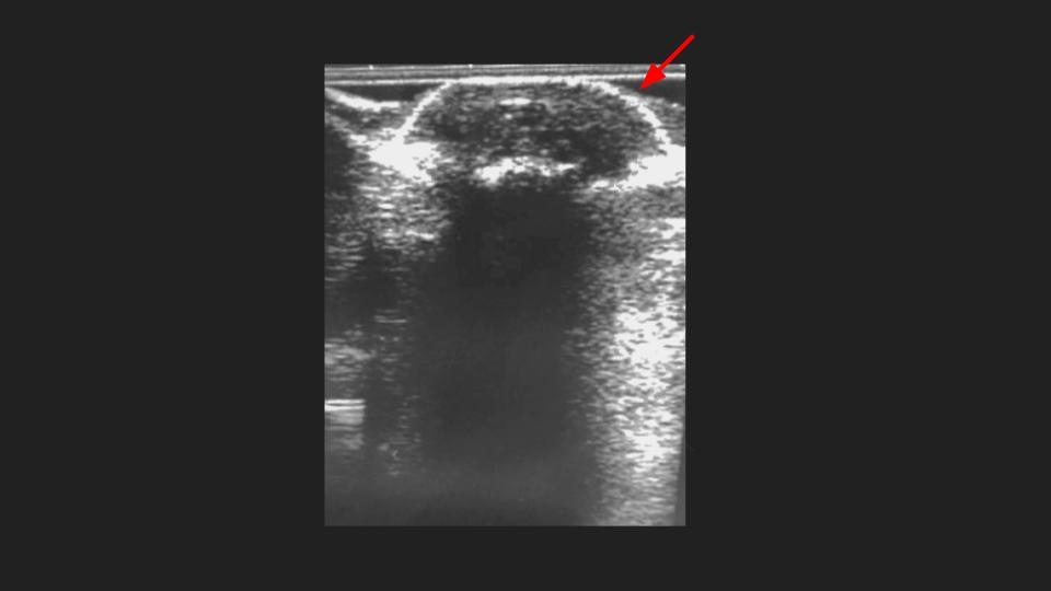Figure 4 for case infectious or inflammatory disease ( RID3381 )